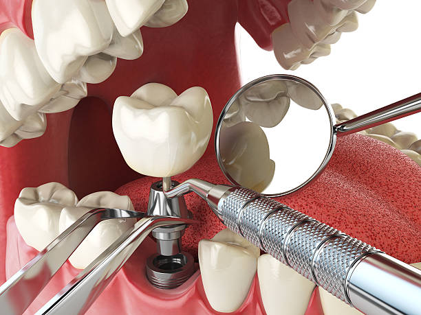 Best Broken or Chipped Tooth Repair in Durham, NC